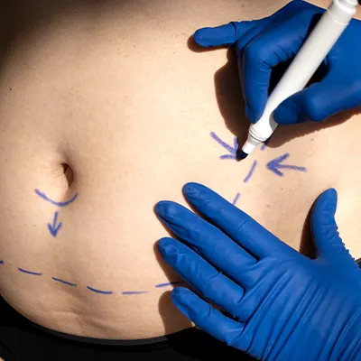 Img-Dr_Carlos_Velasco-Otros_Procedimientos-Abdominoplastia