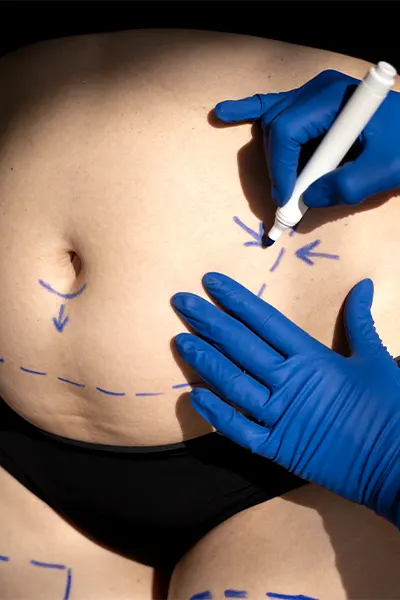 Img-cirujano-plastico-en-cali-Procedimiento-Abdominoplastia