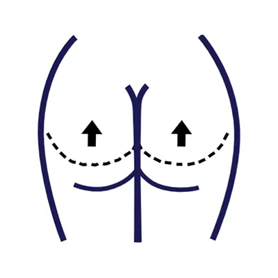 Img-cirujano-plastico-en-cali-Procedimientos-Iconos_Lipotransferencia