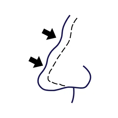 Img-cirujano-plastico-en-cali-Procedimientos-Iconos_Rinoplastia