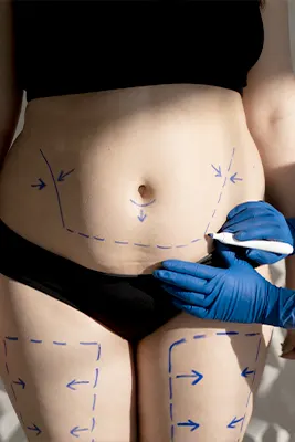 img-cirugia-posbariatrica-en-cali-1-LCP