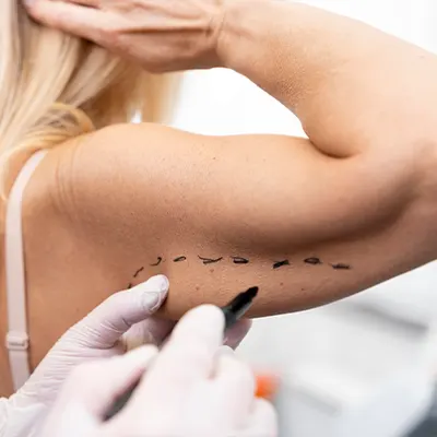 Img-Dr_Carlos_Velasco-Otros_Procedimientos-Arm_lift